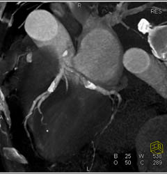 LAD Stenosis With Calcified Plaque - CTisus CT Scan