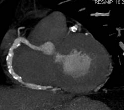 RCA Disease With Calcified Plaque - CTisus CT Scan