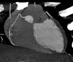 Curve in RCA - CTisus CT Scan