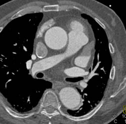 Pseudothrombosis in Atrial Appendage - CTisus CT Scan