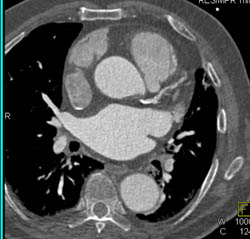 LAD Stenosis - CTisus CT Scan