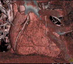 Normal RCA and LAD - CTisus CT Scan