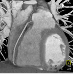 Normal RCA and Right Dominant Circulation - CTisus CT Scan