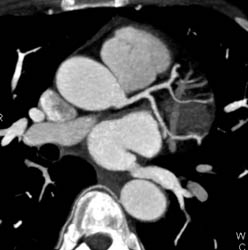 Normal LAD - CTisus CT Scan