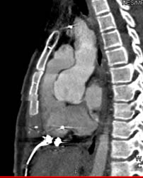 Corrected Togv - CTisus CT Scan