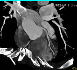 Normal LAD - CTisus CT Scan