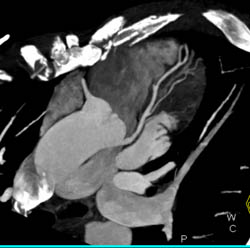 Normal LAD - CTisus CT Scan