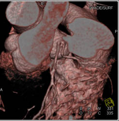 LAD and Circumflex Arise Directly From Left Cusp - CTisus CT Scan