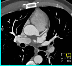 Normal LAD - CTisus CT Scan