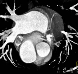 Normal LAD - CTisus CT Scan