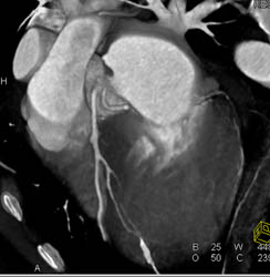 Normal LAD - CTisus CT Scan