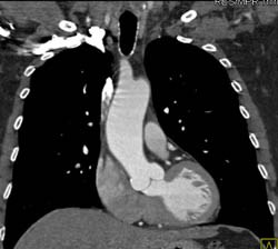 Dilated Ascending Aorta - CTisus CT Scan