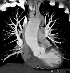 Dilated Ascending Aorta - CTisus CT Scan