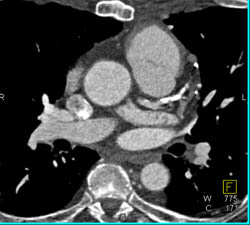 Left Internal Mammary Artery (LIMA) Bypass Due to LAD Disease - CTisus CT Scan