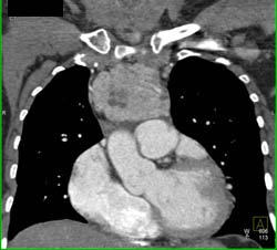 Substernal Thyroid in Patient With Chest Pain - CTisus CT Scan