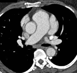 Persistent Left Superior Vena Cava (SVC) Empties Into the Coronary Sinus - CTisus CT Scan