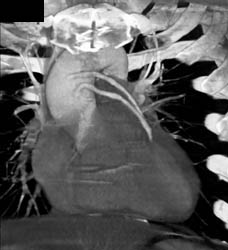 Patent Venous Bypass Grafts - CTisus CT Scan