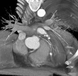 LAD Disease - CTisus CT Scan