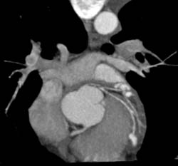 LAD Disease - CTisus CT Scan