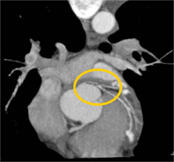 LAD Disease - CTisus CT Scan