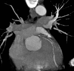 LAD Disease - CTisus CT Scan