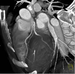 Pseudolesion in Ramus Intermedius - CTisus CT Scan