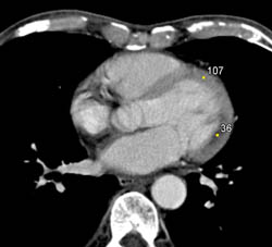 Myocardial Infarction- See Lower Density Zone - CTisus CT Scan