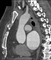 Pseudo clot in Atrial Appendage - CTisus CT Scan