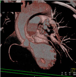 Dissection in Aortic Root - CTisus CT Scan