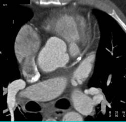 LAD Plaque - CTisus CT Scan