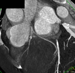 Calcified Plaque on LAD - CTisus CT Scan