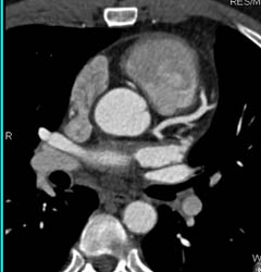 RCA Arises Off Left Cusp - CTisus CT Scan