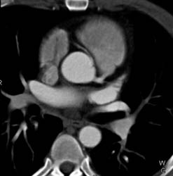 RCA Arises Off Left Cusp - CTisus CT Scan