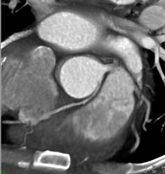 RCA Arises Off Left Cusp - CTisus CT Scan