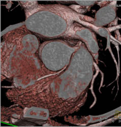 RCA Arises Off Left Cusp - CTisus CT Scan