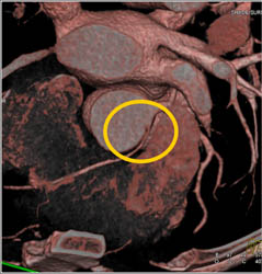 RCA Arises Off Left Cusp - CTisus CT Scan