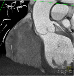 RCA Arises Off Left Cusp - CTisus CT Scan