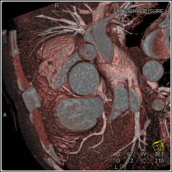 RCA Arises Off Left Cusp - CTisus CT Scan