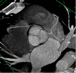 RCA Arises Off Left Cusp - CTisus CT Scan