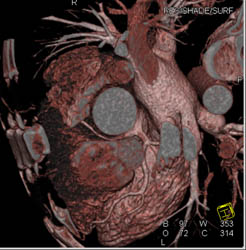 RCA Arises Off Left Cusp - CTisus CT Scan