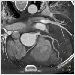 RCA Arises Off Left Cusp - CTisus CT Scan