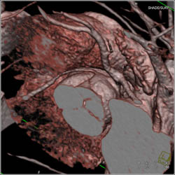 RCA Arises Off Left Cusp - CTisus CT Scan