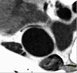 RCA Arises Off Left Cusp - CTisus CT Scan