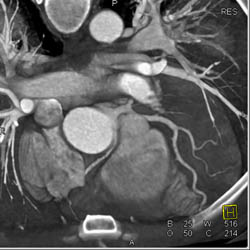 RCA Arises Off Left Cusp - CTisus CT Scan