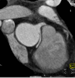 RCA Arises Off Left Cusp - CTisus CT Scan