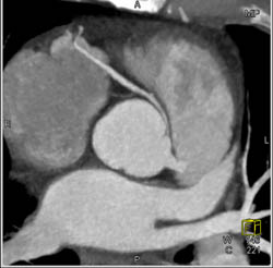 RCA Arises Off Left Cusp - CTisus CT Scan