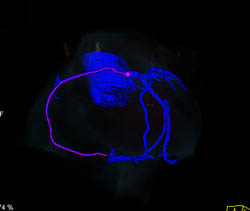 Normal RCA Off Left Cusp - CTisus CT Scan