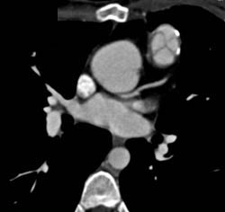 Pulmonary Valve Calcification - CTisus CT Scan