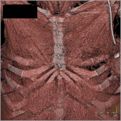 Prominent Ribs and Ribs Removed - CTisus CT Scan