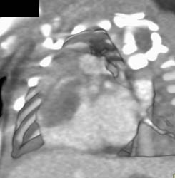 Sarcoma - CTisus CT Scan